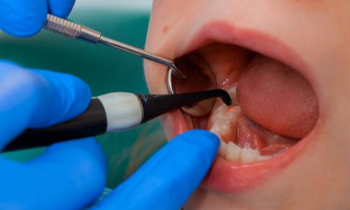 Стала возможна диагностика кариеса до разрушения зуба