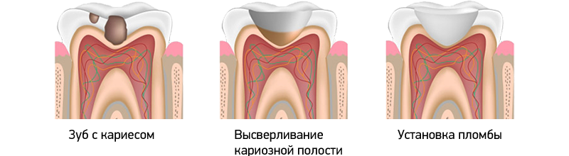 Этапы пломбирования зубов