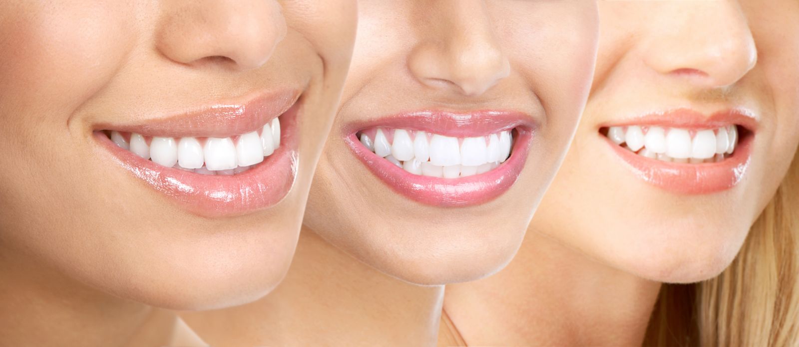 Пример реставрации передних зубов