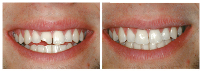 Фото зубов до и после восстановления