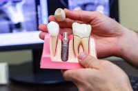 В РФ начнут выпускать биосовместимые зубные импланты