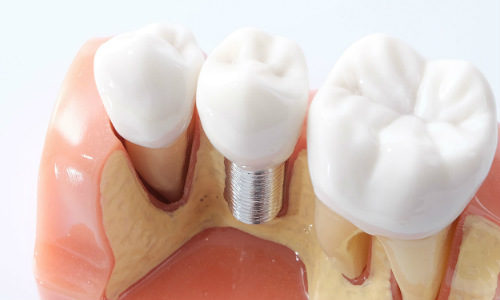 Разработан метод, предотвращающий отторжение зубных имплантов
