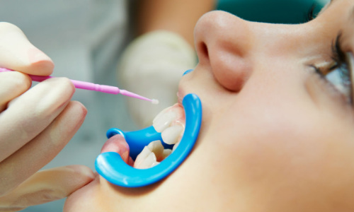 Фторирование зубов – защита от кариеса