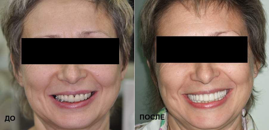 Зубы до и после имплантации